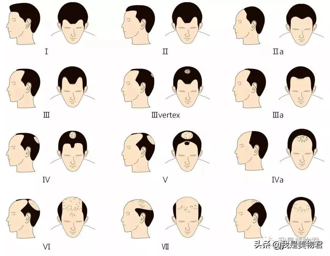 男人的秃顶秘密，设计发型的奇妙之旅