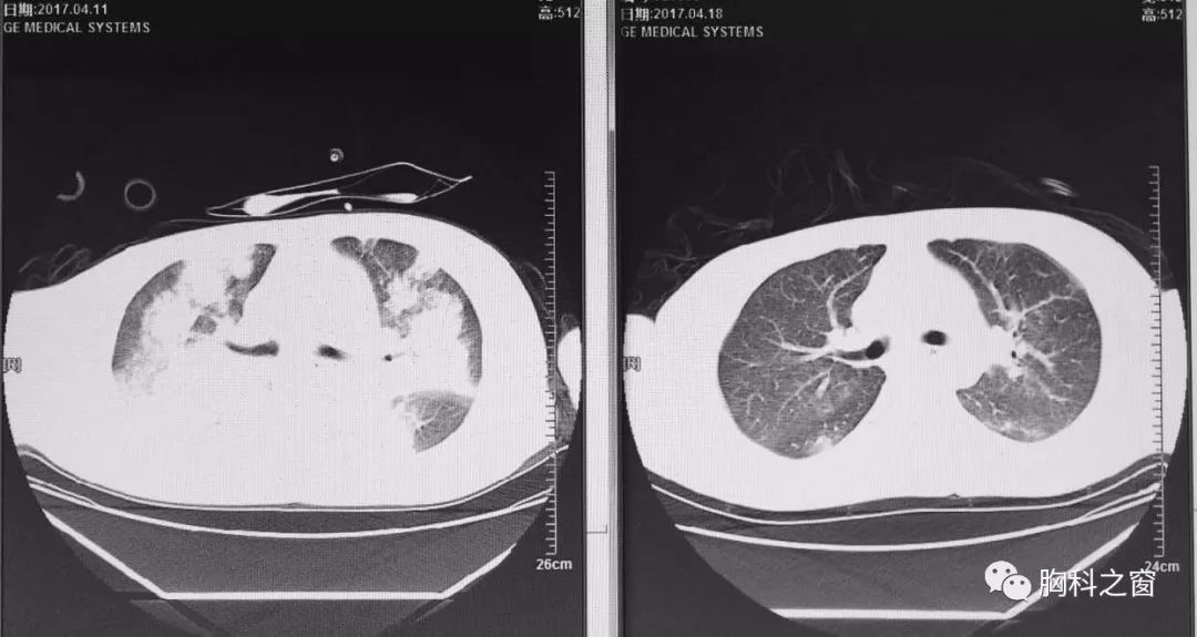 甲型流感病毒性肺炎，深度解析与应对之道