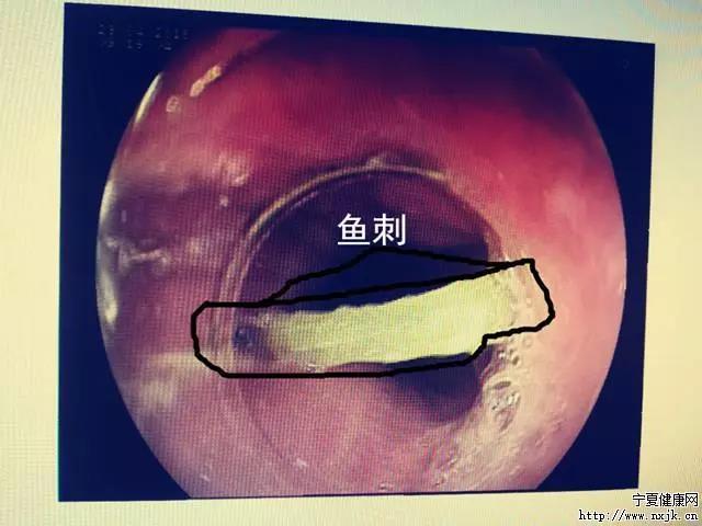 男子遭4cm鱼刺卡喉