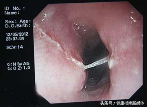 鱼刺卡喉吃馒头压一压？不科学