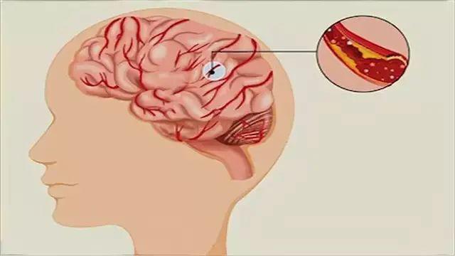 脑梗发作前兆，身体三部位可能变硬迹象解析